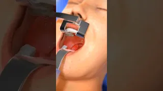 عمليه استئصال اللوزتين Shorts 