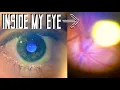 Download Lagu Building the simplest device to look inside the eye (direct ophthalmoscope)