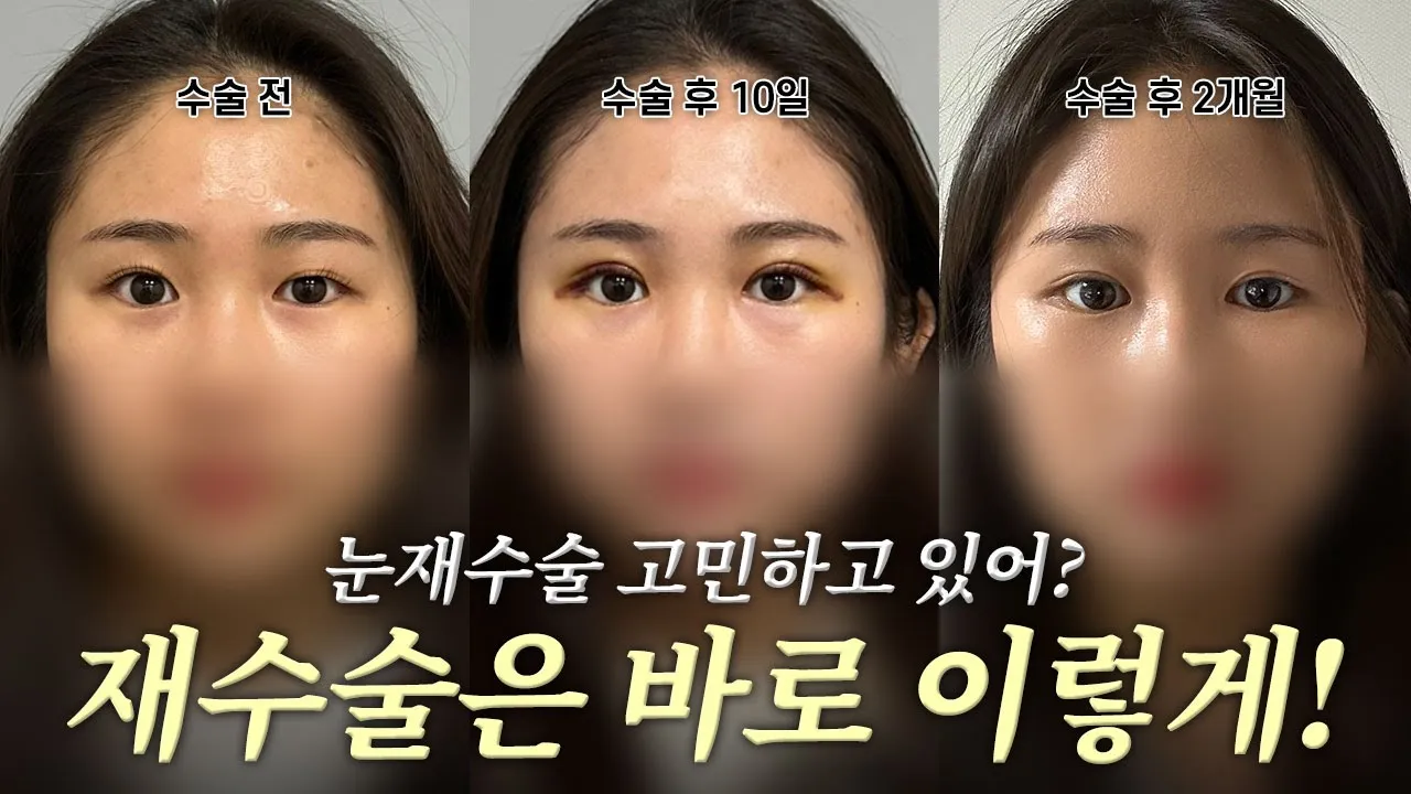 가만히 있어도 졸려보이고 흐린눈이라면? 눈매교정으로 해결하자! | 성형 쇼츠 모음▶️