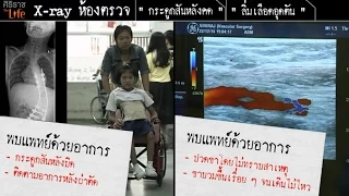 สาเหตุหลักของโรคสมองพิการ หรือ Cerebral Palsy คืออะไร