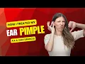 I Got an Ear Pimple and It Was Unbearably Painful Here s What Happened