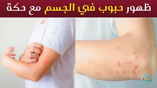 ظهور حبوب في الجسم مع حكة 
