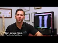 Dr Brian Paris 5 Worst Foods for Arthritis