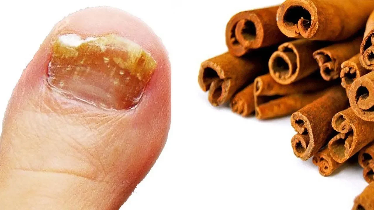 Nagelpilz in wenigen Tagen loswerden ▻Hier kostenlos unseren Kanal Abonnieren: http://bit.ly/1NNwslD. 