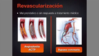 Cardiopatía isquémica 1 ¡Todo lo que debes saber!