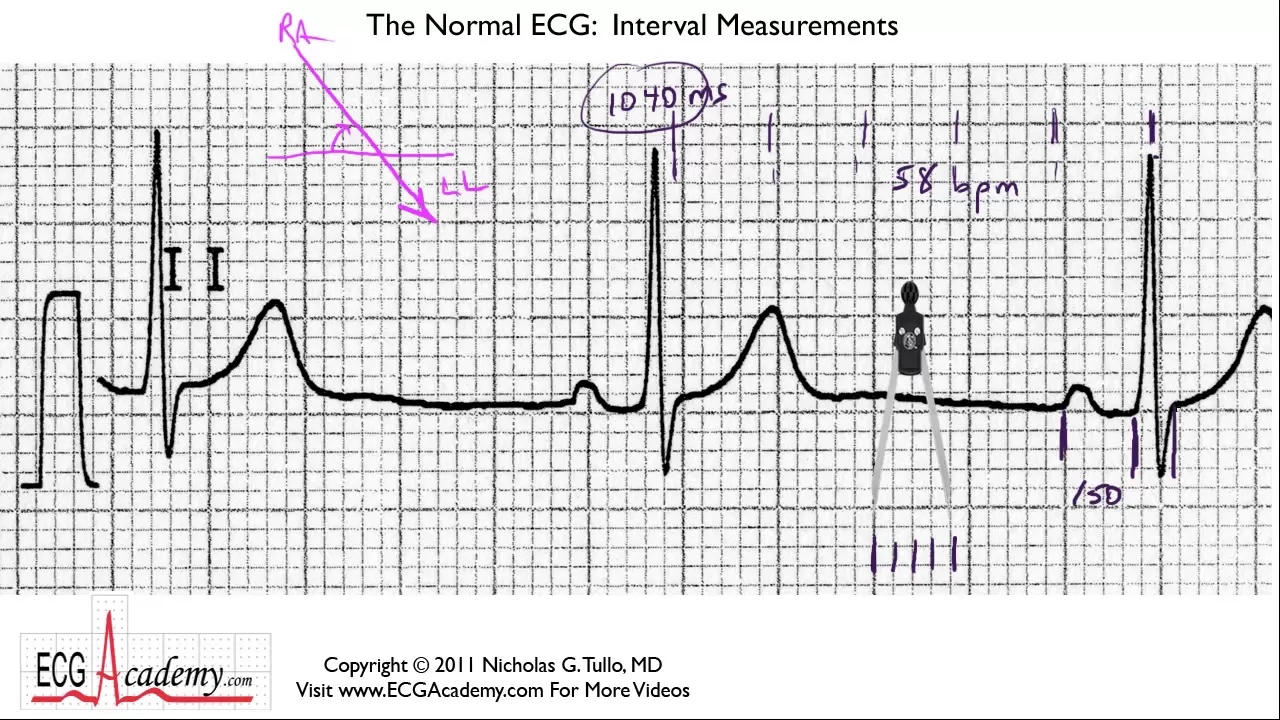 Interval Measurements 6-4 - ECG / EKG Interpretation -- BASIC