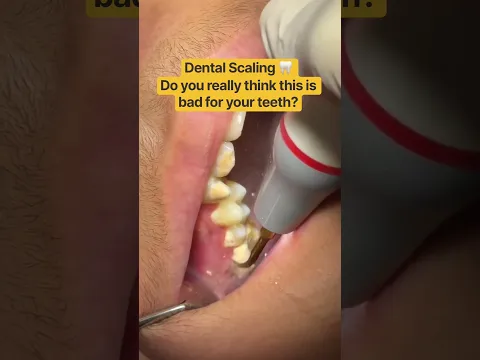 DENTAL SCALING 😬🦷