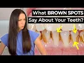 What Do BROWN SPOTS on Your Teeth Mean