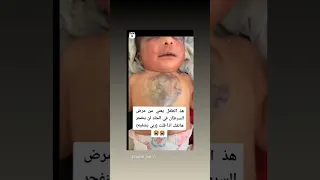 طفل يعاني من السرطان في الجلد لن ينفجر هاتفك اذا قلت ربي يشفيه 