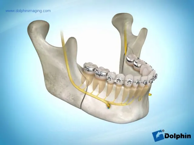mandibular Advancement