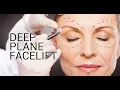 Deep Plane Face Lift with North Beach Plastic Surgery s Dr Rosenblum
