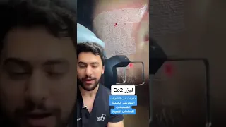ليزر علاج ندبات حب الشباب والتصبغات   دكتور يوسف دندنها