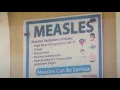 Measles case confirmed in McLennan County