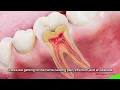 Cracked Tooth and Nerve Damage