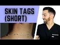 Download Lagu Skin Tags aka Acrochordons #shorts