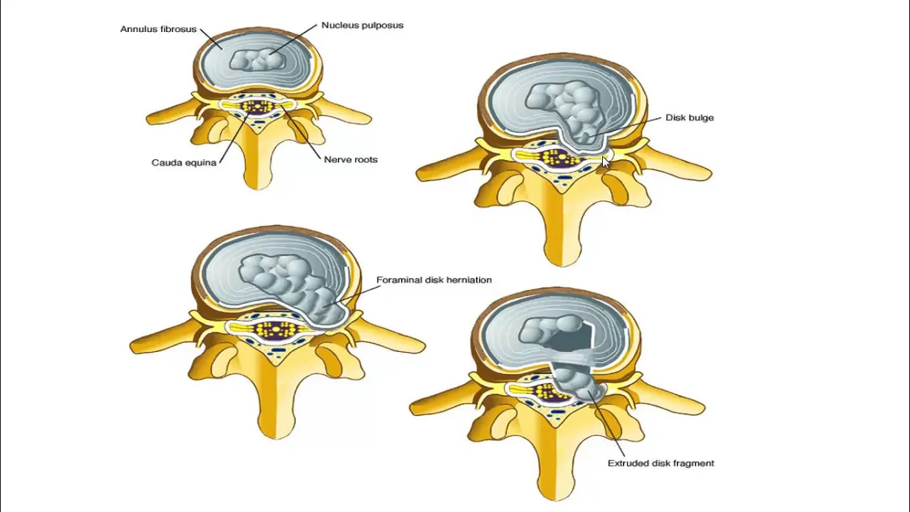 Cara Atasi Syaraf Kejepit atau (HNP) Herniated Nucleus Pulposus dengan Korset Lumbar Support WB 527 . 