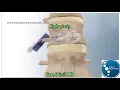 Should I have Surgery On My Lumbar Compression Fracture