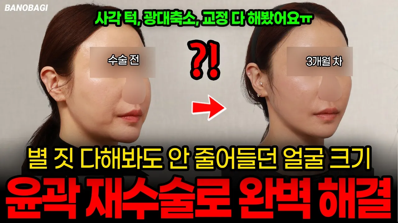양악수술과 윤곽 수술의 차이는?🔥 양악 수술 + 윤곽 수술 실제 환자 케이스 전후 비교 후기 리뷰💛