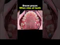 Miss x2 molar teeth and braces