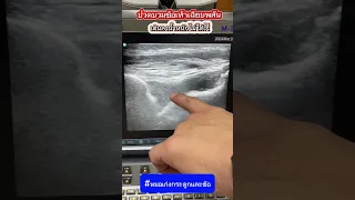  ทำไมข้อเท้าของคนไข้ถึงบวมและเจ็บ 