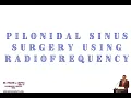 Download Lagu Pilonidale sinuschirurgie met behulp van radiofrequentie