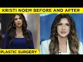 Kristi Noem Before and After Plastic Surgery Cosmetic Surgery Rumors Explained