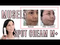My Musely Spot Cream M Update With Before After Pictures of My Melasma