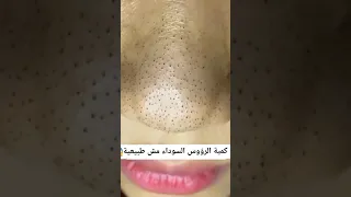 ازالة الرؤوس السوداء 