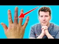 A sudden bruise on the finger Achenbach Syndrome explained Causes symptoms and treatment