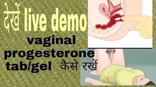 Download live video insert vaginal#progesterone susten cap/gel#iui#ivf#embryotransfer#pregnancy#susten200 MP3