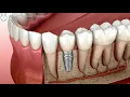 Lagu Animated Dental Implant Procedure | Apollo Medical Travel