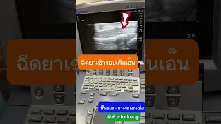  นิ้วล็อคเกิดจากอะไร และมีวิธีรักษาอย่างไรบ้าง 