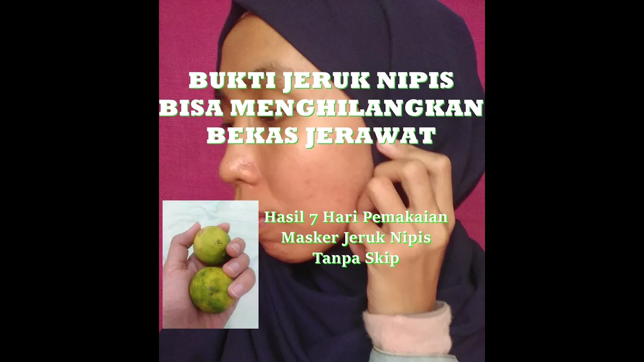 
          
          
          
            
            Cara Alami Meghilangkan Bekas Jerawat (7 Hari Pemakaian Jeruk Nipis Tanpa Skip)
          
        . 