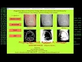 Python Project On Fingernail Disease Detection With Source Code Fingernail Disease Analysis