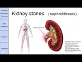 Kidney stones nephrolithiasis