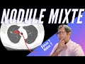 Download Lagu Nodule mixte chez une ex-fumeuse : c’est bénin… ou c’est déjà trop tard ?