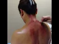 Total Wellness Acupuncture - Gua Sha