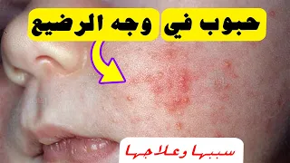 سبب ظهور حبوب في وجه الرضيع 