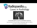 Download Lagu Low phospholipid-associated cholelithiasis syndrome (Radiopaedia.org) Cases in Radiology