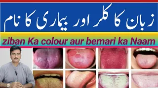 زبان کا کلر اور بیماری کا نام Ziban Ka Colour Aur Bemari Ka Naam Tongue Shahidawakhana Foryou 