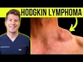 Doctor explains WARNING SYMPTOMS and SIGNS of HODGKIN S LYMPHOMA CANCER