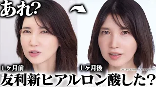 【ヒアルロン酸入れた？】問い合わせ多数。友利新の１ヶ月の変化