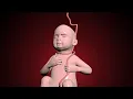 Download Lagu Nuchal cord - umbilical cord becomes wrapped around the fetal neck 360 degrees. #education