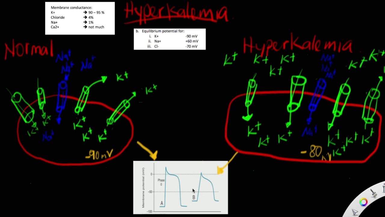 Hyperkalemia - The effects of hyperkalemia on resting membrane potential - depolarized - why & how