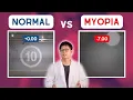 MYOPIA vs normal vision POV