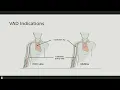 Preventing hospital acquired MRSA blood stream infections