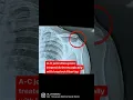 Download Lagu Metal Free fixation of AC joint Dislocation