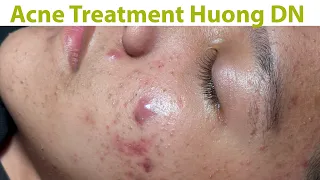 Acne Treatment Huong Da Nang#752#Huong's staff_ Blackheads Long time no see.