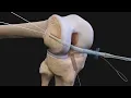 Arthrex ACL Reconstruction