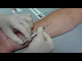 Tb Skin Test Placement